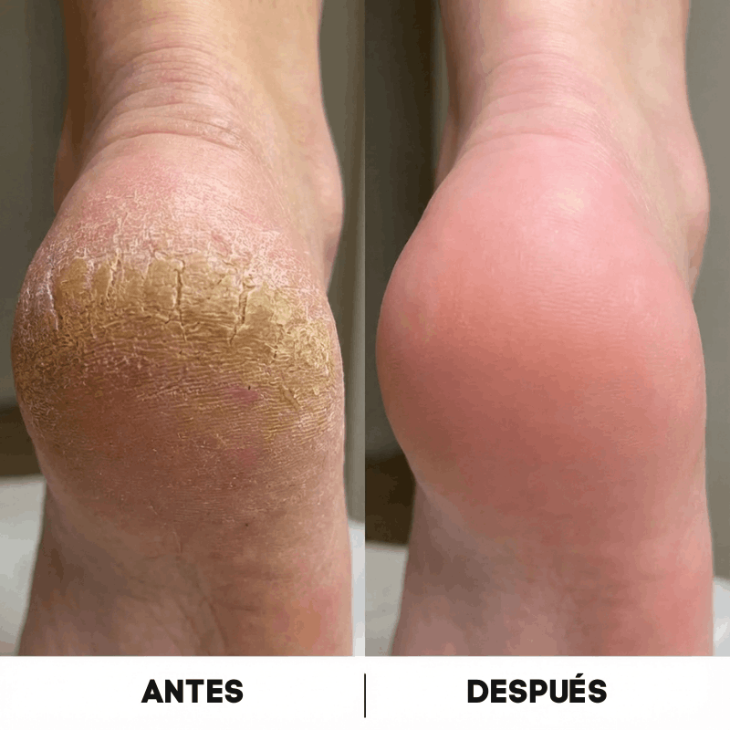 Exfoliador | Saca callos