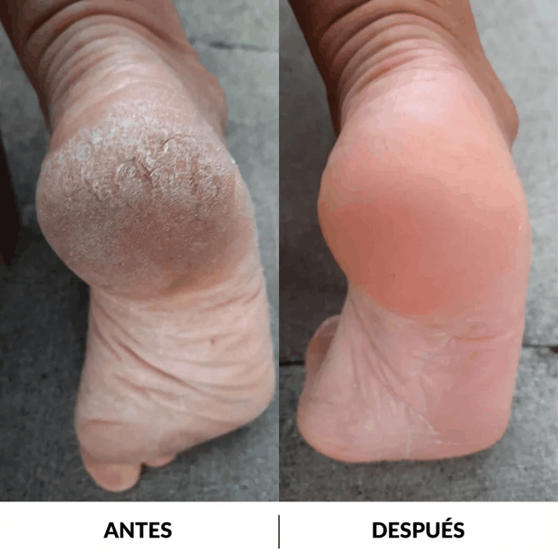 Exfoliador | Saca callos