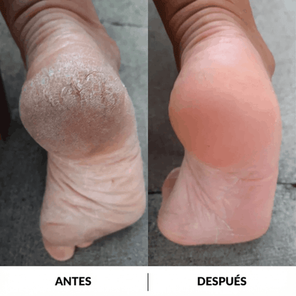 Exfoliador | Saca callos